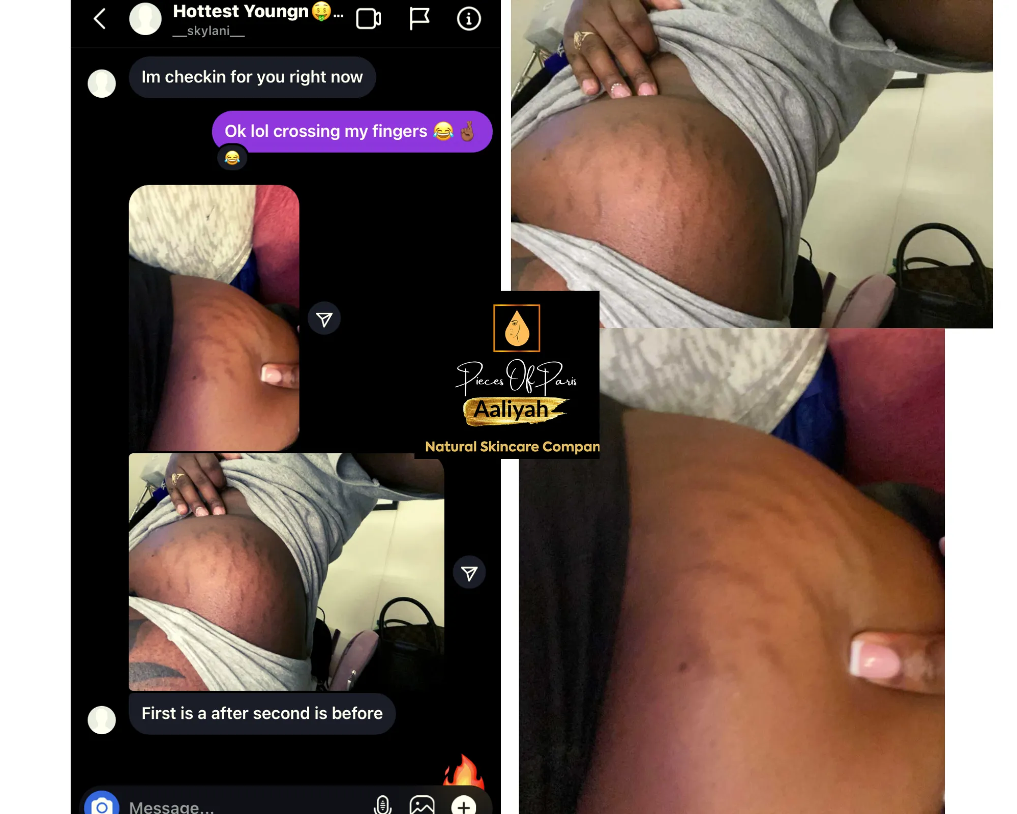 Stretch Mark Oil