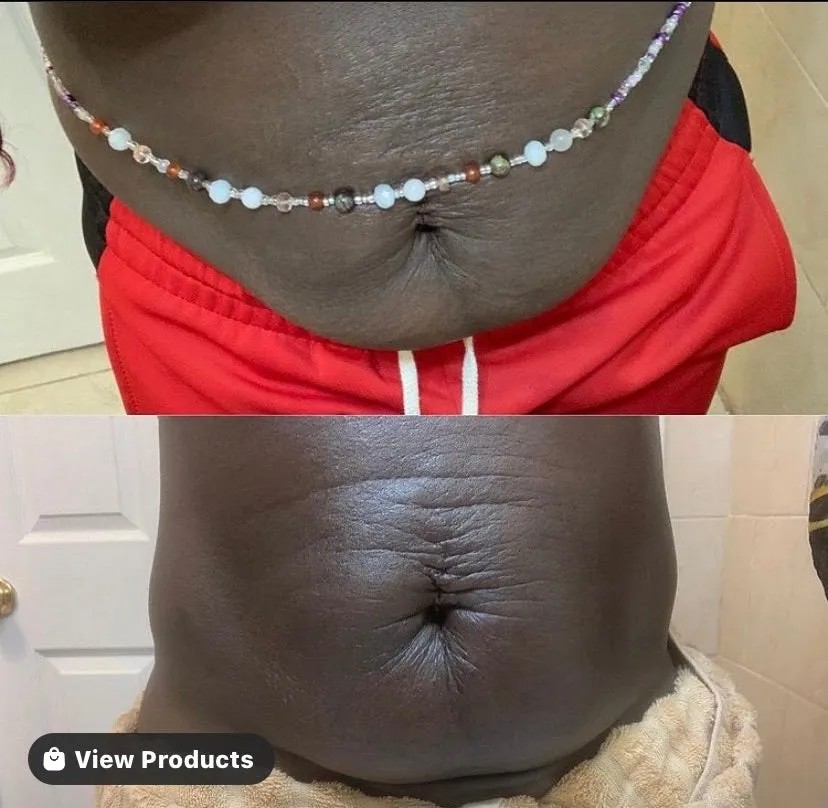 Stretch Mark Oil